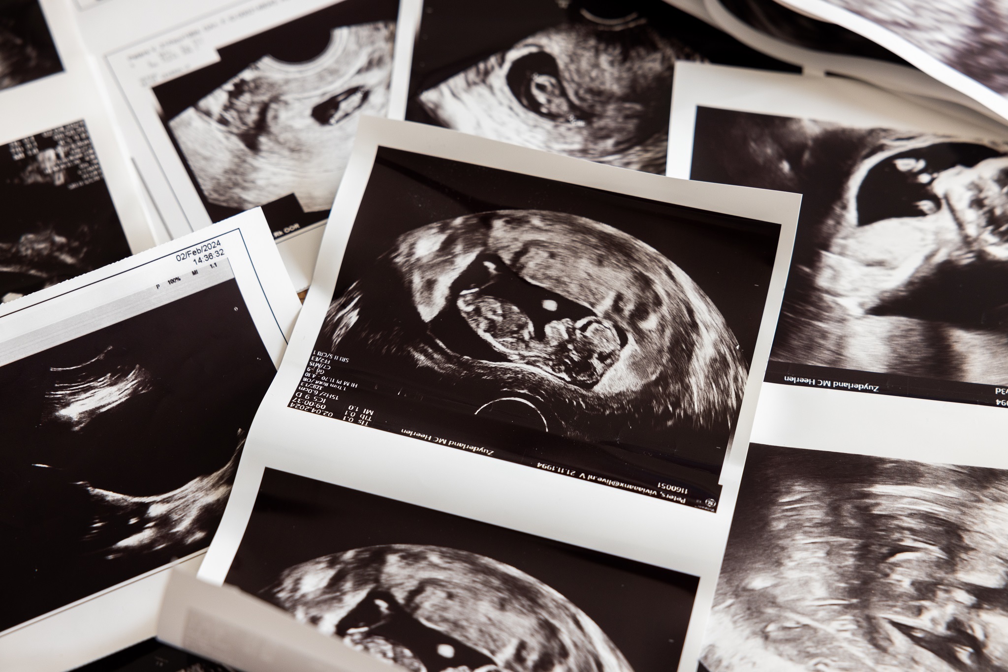 Foto's van een echo van een baby